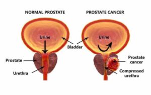 normal to cancer