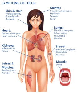 Symptoms of Lupus Disease