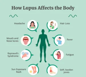 How Lupus Disease affects the body