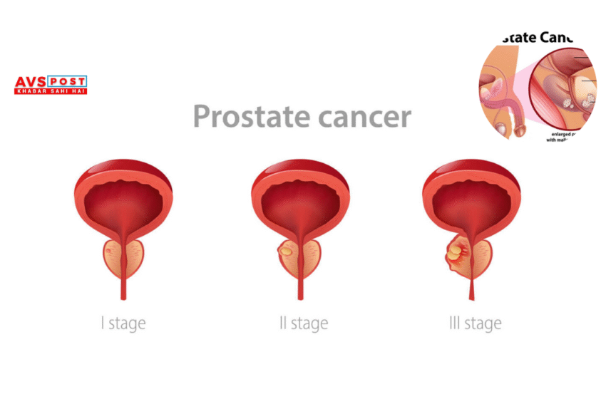 Prostate cancer : लक्षण, कारण, उपचार और समय रहते पहचान क्यों है ज़रूरी